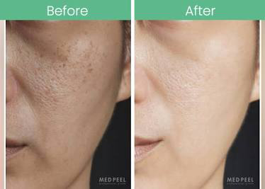Retinol Yellow Peels